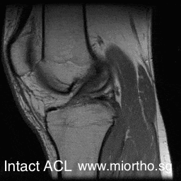 ACL MRI