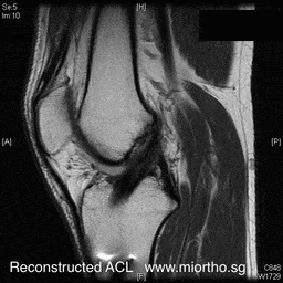ACL MRI