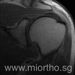 rotator cuff