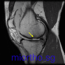 Knee MRI