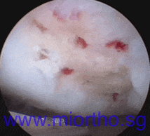 cartilage injuries