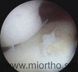 Shoulder dislocation and labral tears