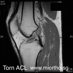 Torn ACL