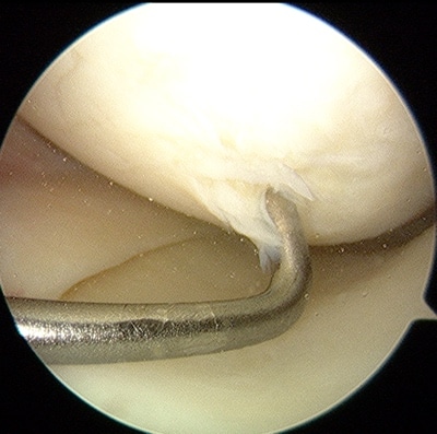 cartilage