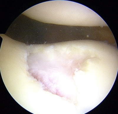 cartilage2